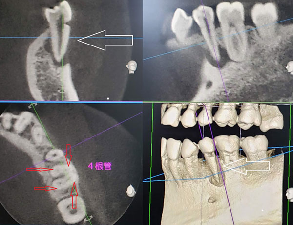 次の症例は、死んだ歯にできた「病巣」が隣の歯まで悪くしたものです。